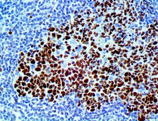 IHC of bcl-6 on a FFPE Colon Tissue